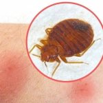 Allergy to bedbug bite