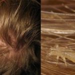 What to do if a child has fleas on his head