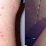 What traces remain after a bug bite?