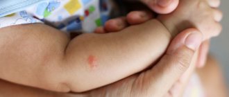 Комариный укус у ребенка