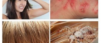Can lice appear on nerves?