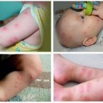 First aid for a child with flea bites: medicines and folk remedies