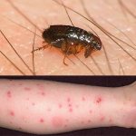 Symptoms of fleas in humans