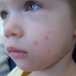 Flea bites: features, symptoms and treatment