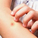 flea bites in children