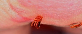 Bedbug bites: photo