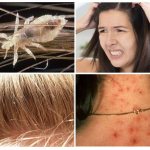 Lice on the human body