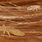 Lice in human hair
