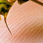 wasp sting